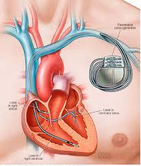 Consentement Stimulateur Cardiaque (pace-maker) - STCCCV