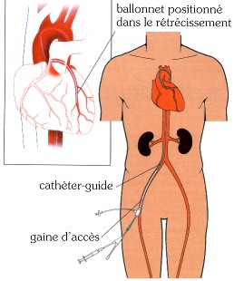 Consentement coronarographie et dilatation coronaire - STCCCV