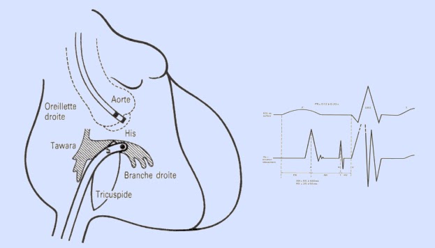 Consentement Exploration Electrophysiologique - STCCCV