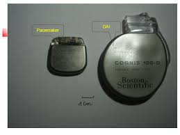 Consentement Défibrillateur Automatique Implantable(DAI) - STCCCV